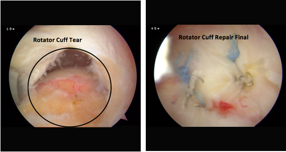 What are some symptoms of a shoulder tear?